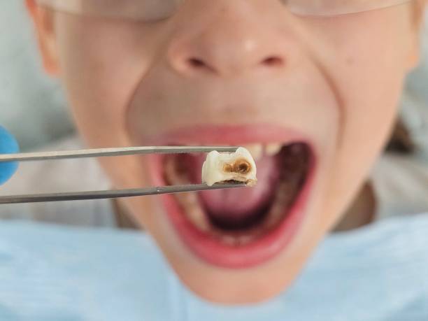Best Teeth Whitening  in Redwood City, CA